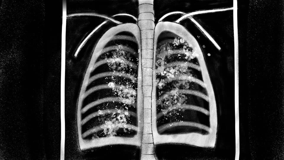 A drawn chest X-ray, the lungs clouded with white specks.
